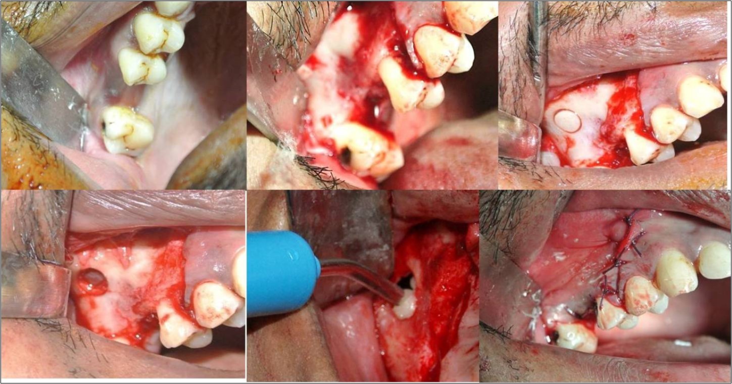 (a-h) Indirect sinus membrane elevation followed by implant placement done in cases with residual bone height of >5mm but <9mm;
