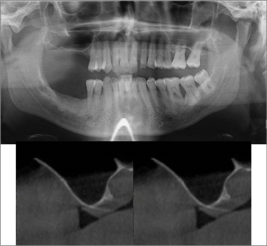 (a-c) Pre-treatment OPG and cross sections of CBCT showing residual alveolar bone height for Case No.1;
