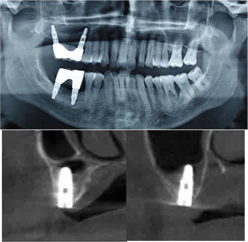 (a-c) Post-treatment OPG and cross sections of CBCT showing residual alveolar bone height for Case No.1;