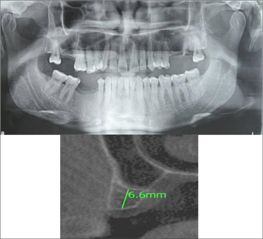 (a,b) Pre-treatment OPG and cross section of CBCT showing residual alveolar bone height for Case No.2