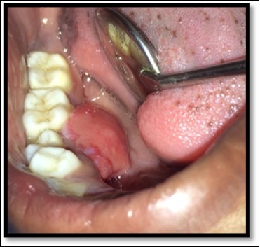 Pre operative size and extent of lesion