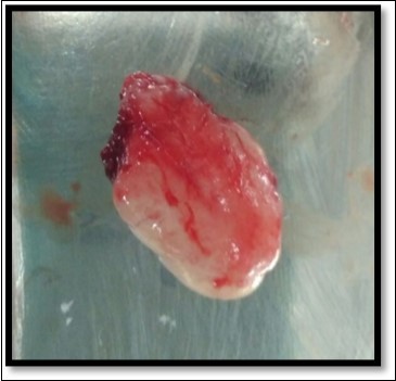 Excised lesion