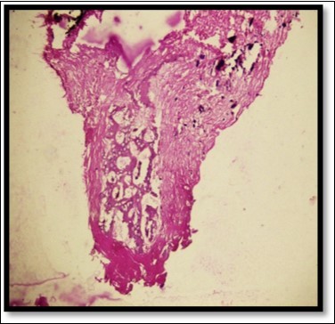 Histologically H & E stained section shows trabecular bone and woven bone more towards the center of the lesion