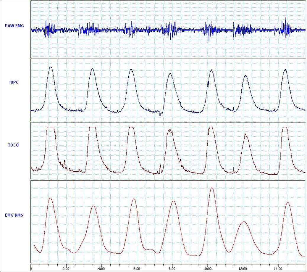 Simultaneous recording and comparison of the signals (from top to bottom): the raw EMG signal, the IUPC recording. The external TOCO recording and the RMS signal from a single subject. Note the exceptional correspondence between RMS-plotted contractions and the IUPC-plotted contractions.