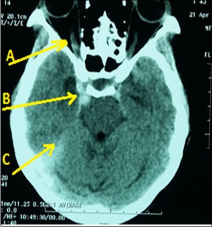 Brain CT scan displaying right CCF (Arrow B) with subarachnoid hemorrhage (Arrow C) and right ophtalmic vein dilatation (Arrow A)