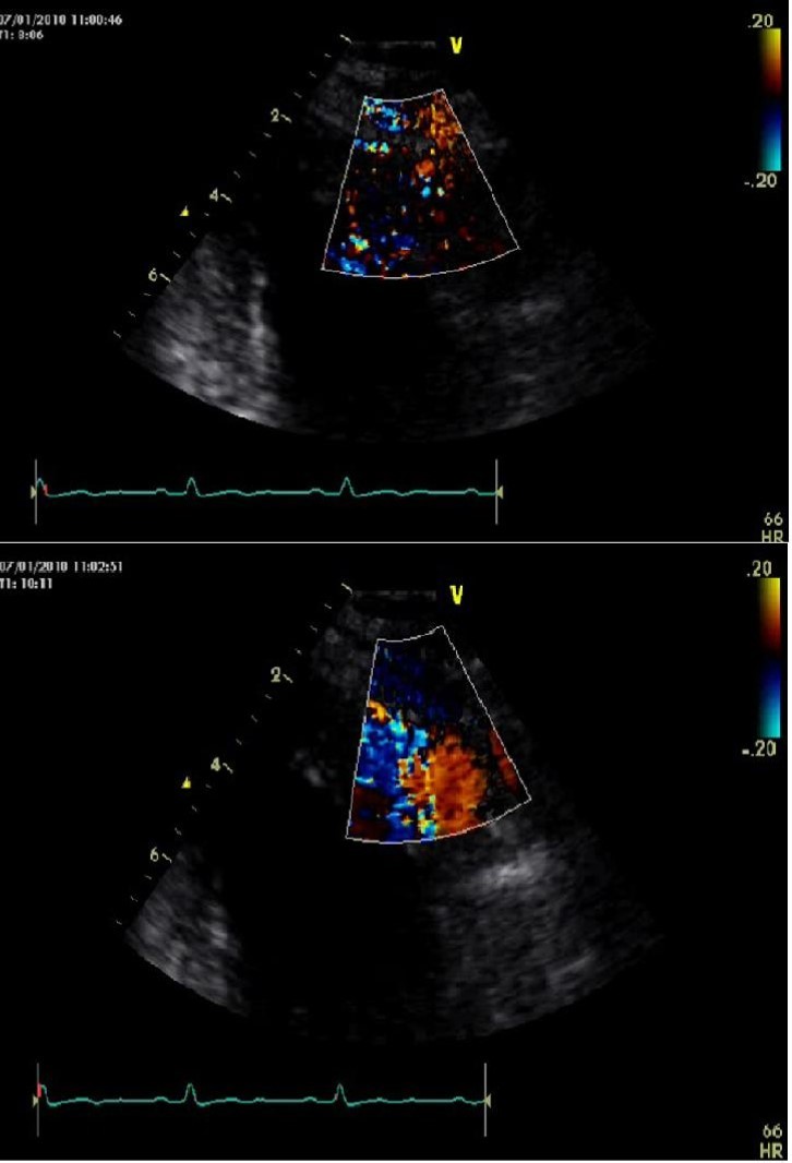 Echo-color Doppler evalutation of left anterior descending artery fistula draining in left ventricular cavity