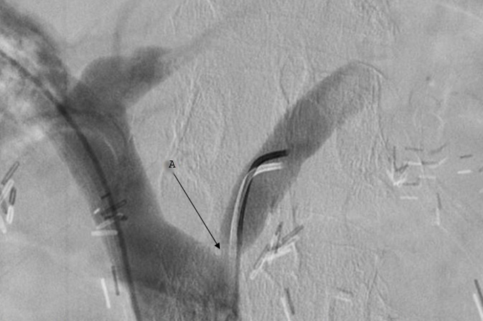 Venogram showing left gastric vein stenosis (A) with proximal vessel dilation.
