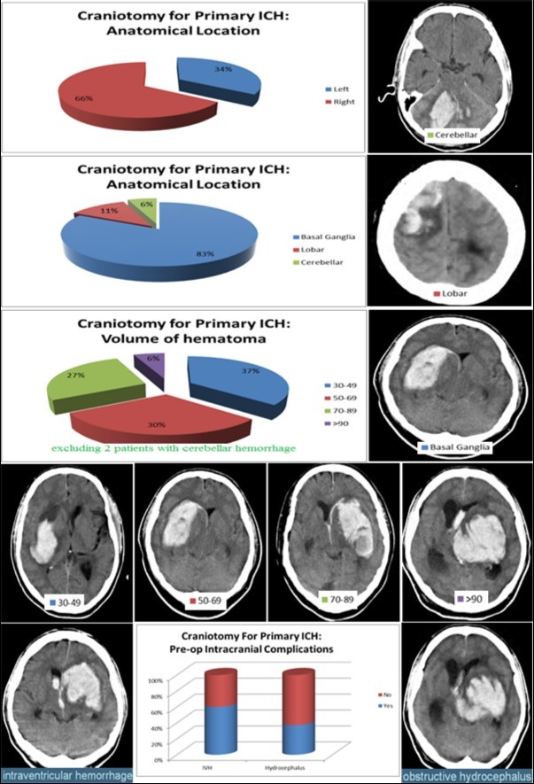 ICH – Anatomical location, volume and its complications