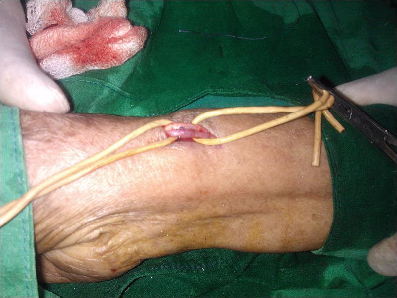 Partially calcified right radial artery is seen lying lateral to the cephalic vein at right anatomical snuff box. A successful side to side anastomosis between the aberrant radial artery and cephalic vein was performed.