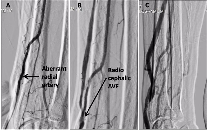 A. Aberrant course of right radial artery. It normally lies above the lateral epicondyle of radius bone, fistulogram demonstrated its course away from radius bone. B. Working right radiocephalic AV Fistula. Right cephalic vein is seen medial to the artery at the site of anastomosis and later running lateral to it. C. A well developed cephalic vein suitable for cannulation for hemodialysis.