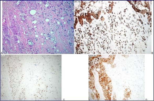 A-95% of tumor is a poorly differentiated squamous carcinoma with rare foci of keratinisation, and <5% of tumor is a poorly differentiated adenocarcinoma, with some isolated cells. B-Both components, squamous carcinoma and adenocarcinoma, are Cytokeratine 7 positive. C- Squamous component shows a nuclear positivity for P63, with negativity of the adenocarcinoma. D-Cytokeratine 5, 6 is positive in the squamous component, but not in the adenocarcinomatous component.