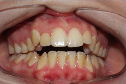 Pretreatment intraoral photography