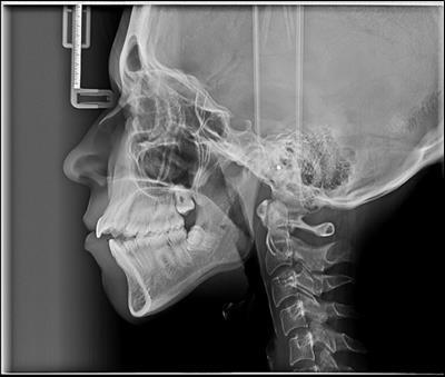 Pretreatment cephalometric film