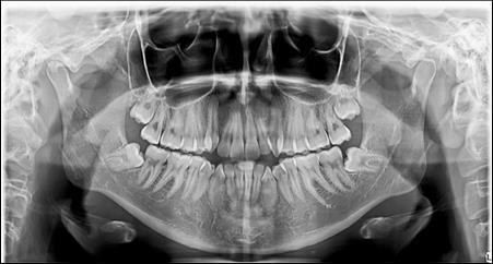 Pretreatment panoramic X-ray
