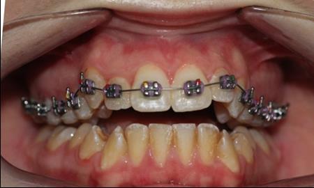 Intraoral photography at the start of the treatment.