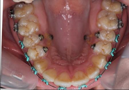 Intraoral photography after the mini-implant activation