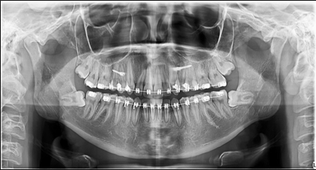 Panoramic X-ray before the removal of the third molars.