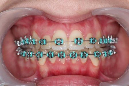 Clinical situation after intrusion with orthodontic implants.