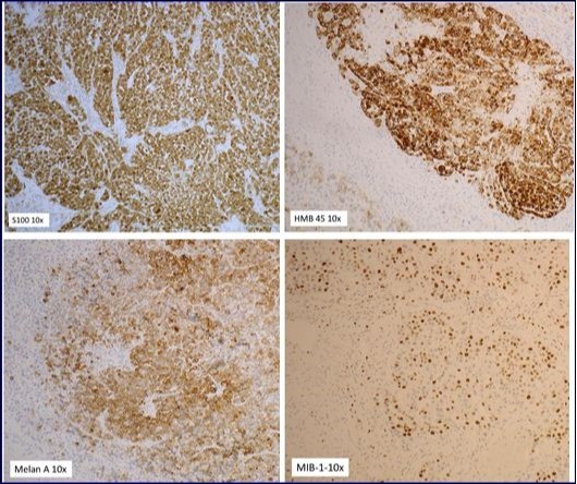 The immunohistochemistry for both S100 and HMB 45 were positive
establishing diagnosis of primary malignant melanoma of the parotid.