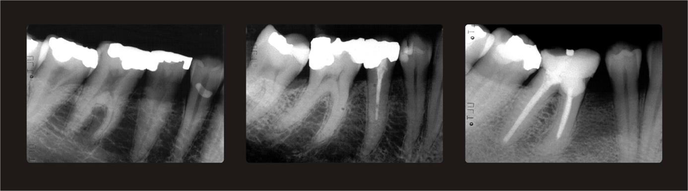 Periapical reference radiographs.Left: Sparse trabeculation with large intertrabecular spaces and almost invisible trabeculae. Middle: Mixed dense and sparse trabeculation with small intertrabecular spaces cervically and larger spaces more apically. Right: Dense trabeculation with small intertrabecular spaces.