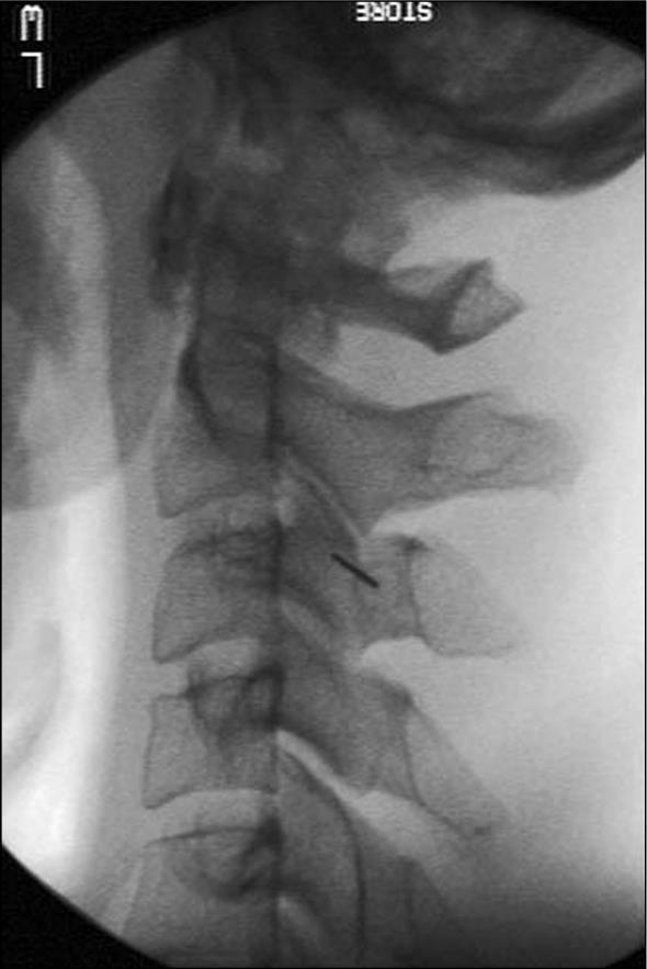 Lateral fluoroscopic view with the needle in position for a C3 medial branch block.