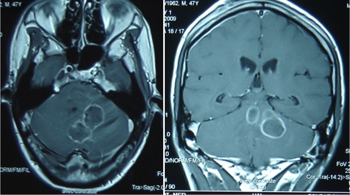 cerebral MRI axial T1-weighted (A) and coronale (B), showing a multiples well circumscribed posterior fossa lesions
