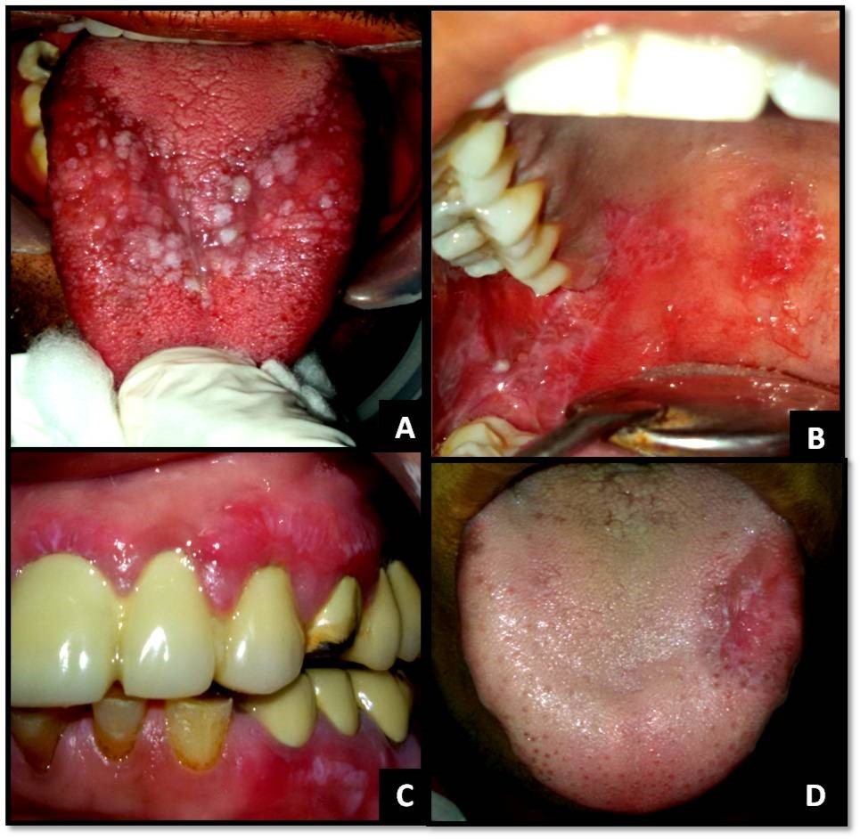 (A) Papular and plaque-like OLP on dorsal aspect of tongue; (B) Reticular and erosive OLP on the palate; (C) Reticular OLP on gingiva with desquamative gingivitis; (D) Reticular and erosive OLP on the tongue