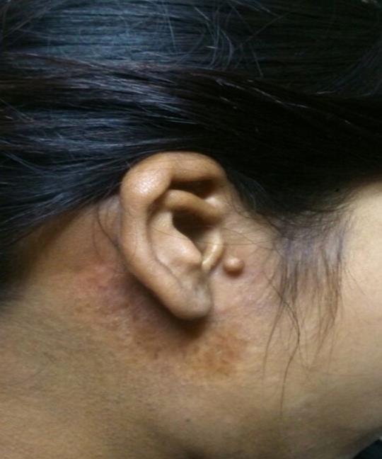 showing Right grade II microtia
