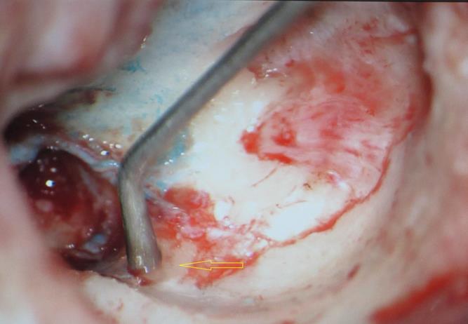 Arrow pointing towards oval window area