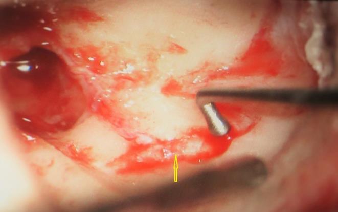 Arrow pointing to exposed facial nerve (vertical segment)