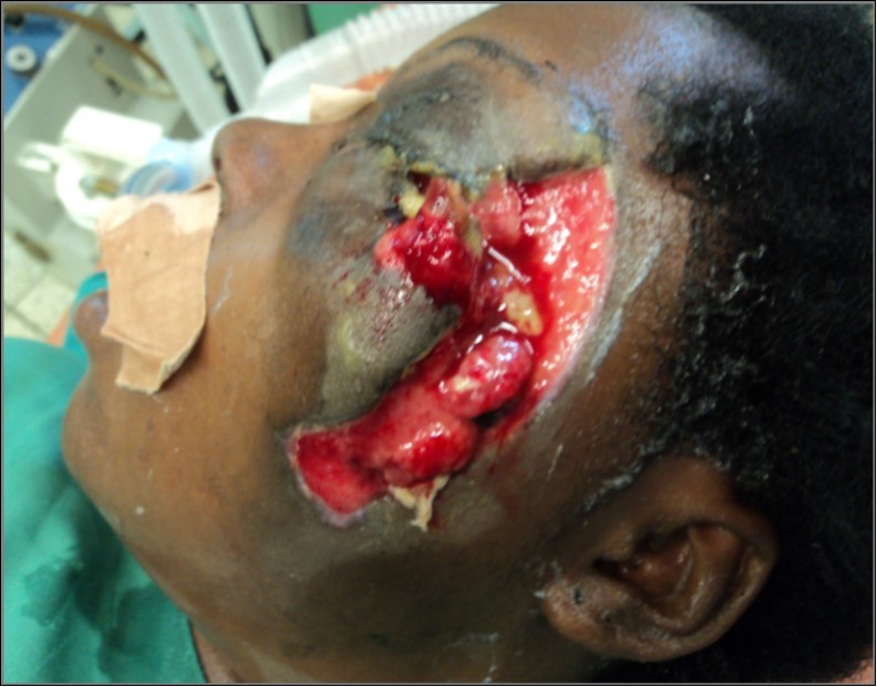 The picture of a passenger who sustained severe injuries involving loss of a left eye