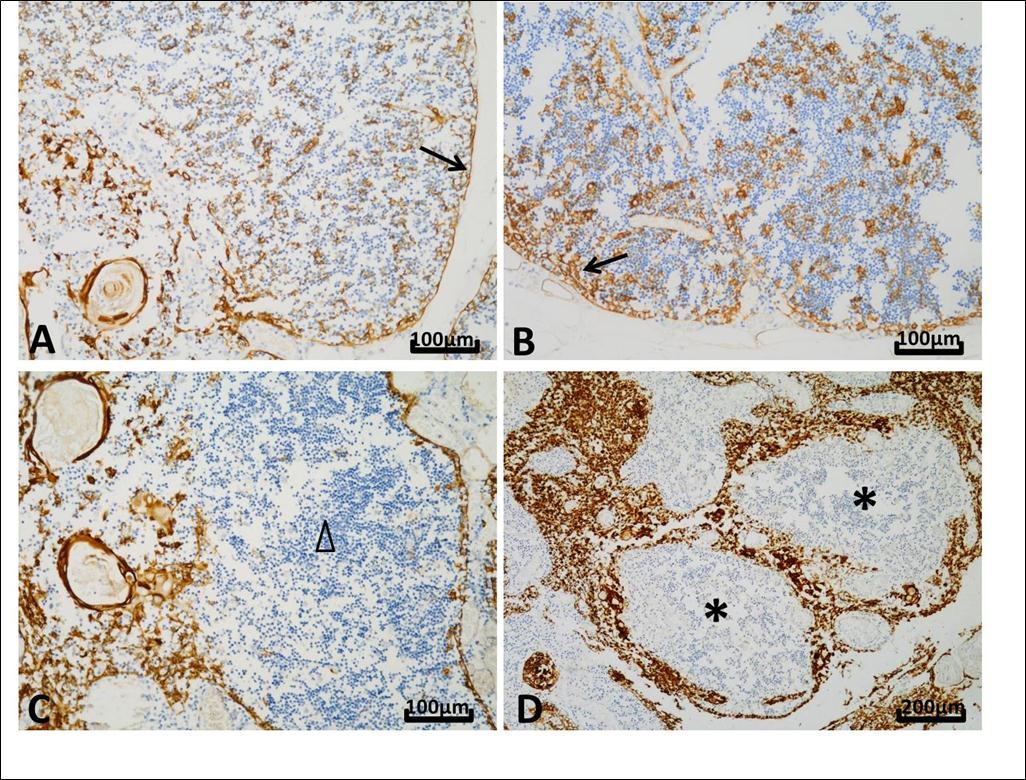 Different patterns of CK19 expression in thymuses. Nuclei were stained in blue by hematoxylin and positive reaction appeared brown. A, Thymus from a 16-month child who died of interstitial pneumonia. The whole epithelial network expressed CK19 forming a meshwork structure in the cortex and the medulla (original magnification, ×200). B, The number of CK19-positive subcapsular cells was more in the thymus from a female of 29 years old with SUDA, who diagnosed as thrombocytopenic purpura and died of infectious shock, than that seen in the child thymus (original magnification, ×200). C, Thymus from a 27-year old man with cardiac sudden death and accompanied by adrenal pheochromocytoma. Reactivity with CK19 was little or absent in the medulla (△) (original magnification, ×200). D, A female of 20 years old who died of Crohn’s disease with perforation. B cells presented nodular hyperplasia and formation of lymphoid follicles (*). Their presence was accompanied by a disorderly arrangement and hypertrophy of medullary epithelial cells. The pushed epithelial cells were packed and showed strong CK19 expression (original magnification, ×100).