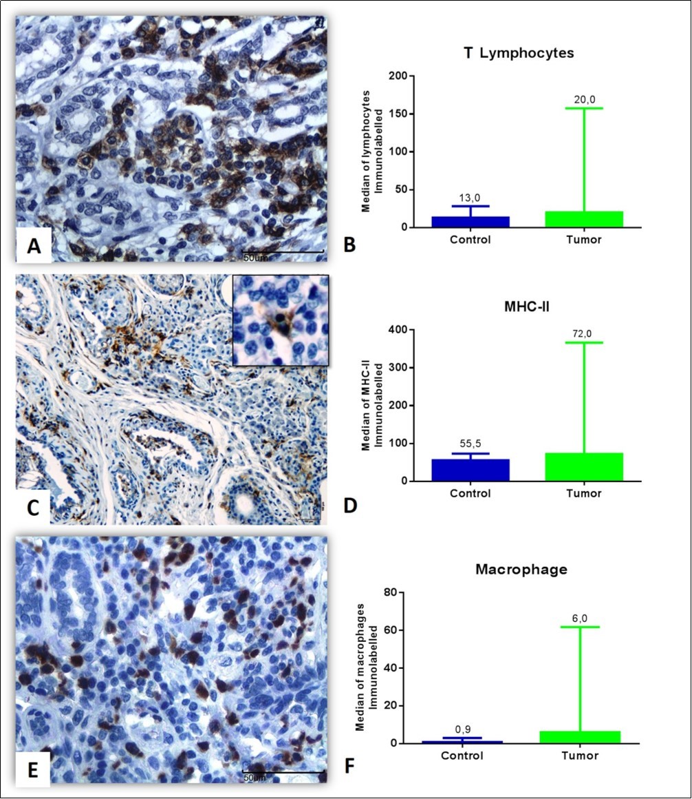 Inflammatory infiltrate associated with the mammary tumor in female dogs. (A) Photomicrography of intratumoral T lymphocytes in grade I tubular carcinoma. (B) T lymphocyte median in the control and tumor groups (p = 0.221). (C) Intratumoral immunostaining of the major histocompatibility complex class 2 (MHC-II) labeling in tubular carcinoma grade III, observe the immunomarked cells in detail. (D) No significant difference was observed between the control and tumor groups (p = 0.0638). (E) Intratumoral macrophages in grade II tubular carcinoma. (F) Median macrophage markers in the control and tumor groups, with significant differences between groups (p = 0.0139). (A, C, E) Complex of peroxidase-bound polymers (bar = 50 μm). (B, D, F) Non-parametric Mann-Whitney test.