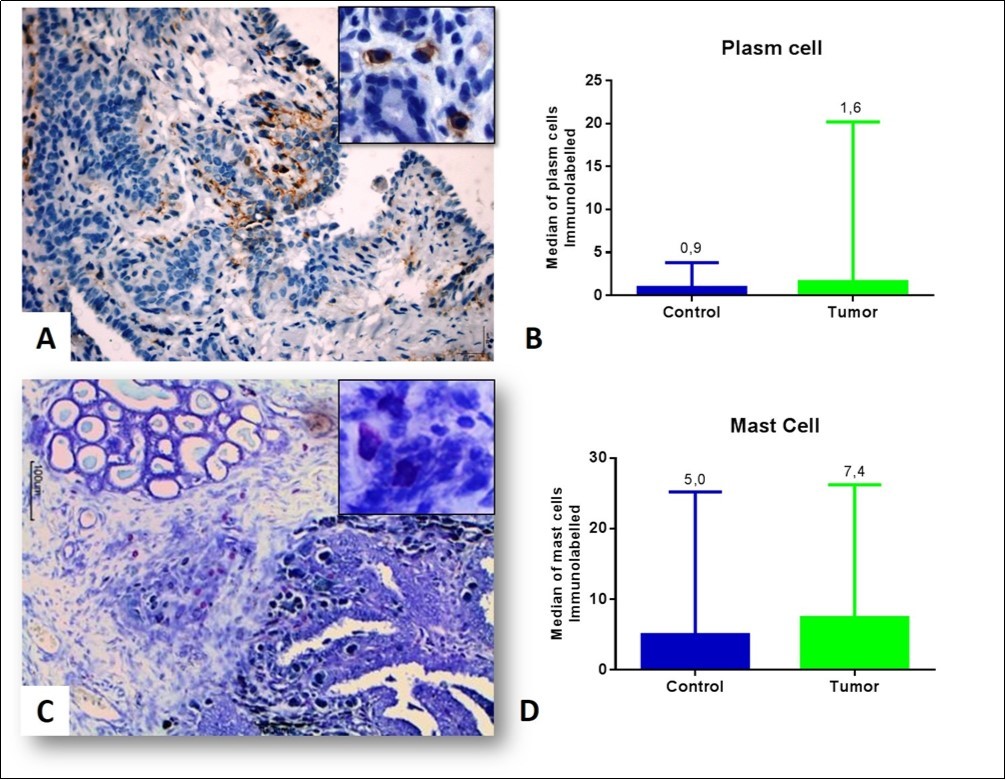 Inflammatory infiltrate associated with the mammary tumor of bitches (A) Plasm cells visualized in a papillary carcinoma grade I, observe the plasm cells in the detail. Peroxidase-bound polymer complex (bar = 50 μm). (B) Plasma cell counts in the control and tumor groups (p = 0.2597, Mann-Whitney test). (C) Intratumoral mast cell infiltrate in grade I papillary carcinoma (detail). Toluidine blue staining (bar = 100 μm). (D) Mean of mast cells in the control and tumor groups (p = 0.3846, Mann-Whitney test).