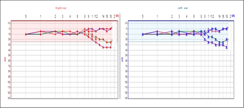 Hearing tests over the months with worse results on high