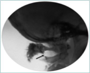 Lateral fluoroscopic image showing the final contrast spread; the arrow shows the outline of the greater occipital nerve at the level of the inferior oblique capitus muscle. Image Courtesy of Gabor Racz, MD