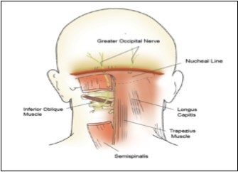 Path of the greater occipital nerve. (Image courtesy of Epimed International®, with permission)