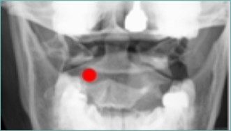 Anterior-posterior fluoroscopic view showing target site for Stealth needleÔ placement, medial to the superior pars of C2. (Image courtesy of Andrea Trescot, MD)