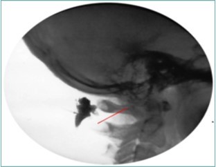 Lateral Fluoroscopic image showing initial contrast location deep to the suboccipital muscles; red line corresponds to the level of the inferior oblique capitus muscle. (Image courtesy of Gabor Racz, MD)