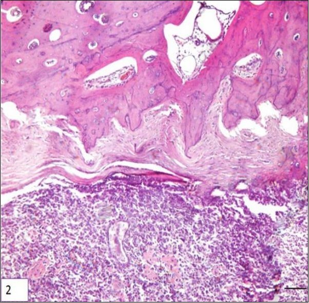 Photomicrography of a sample of canine bone (tibia) showing neoplastic mesenchymal proliferation, originated in bone cells, HE. Periosteal array of tumor cells, bar 200 μm.