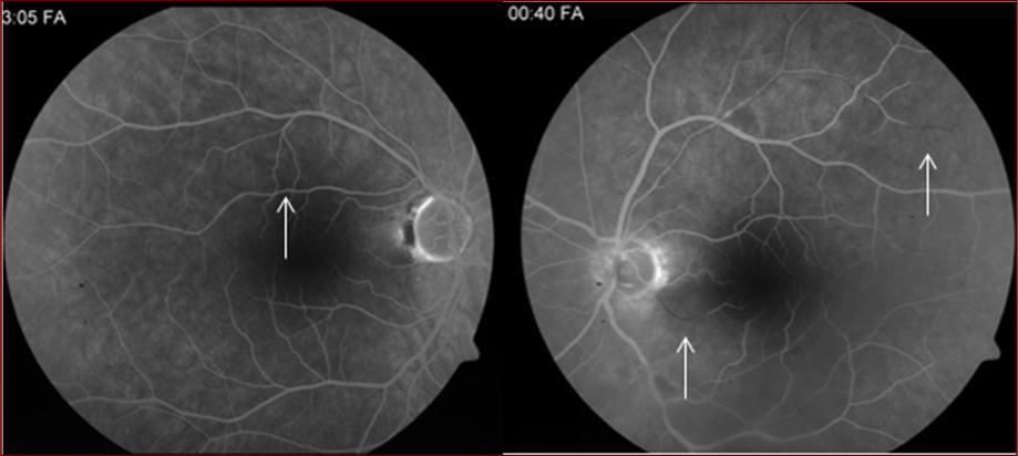 Fluorescein angiography two months after first presentation showing mild capillary drop out in the right eye (arrow) and several arterial occlusions in the left eye (arrows).