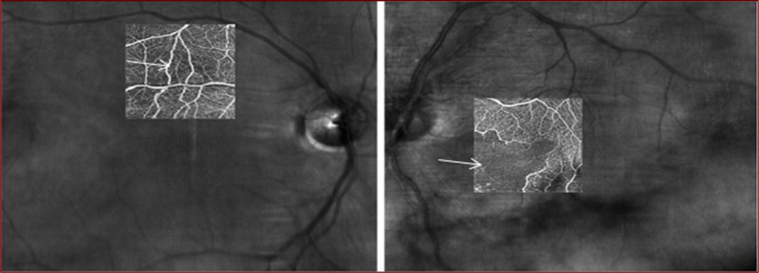 OCT angiography non-segmented images two months after first presentation showing mild loss of inner retinal perfusion of the right and severe loss of perfusion in the left eye (arrows).