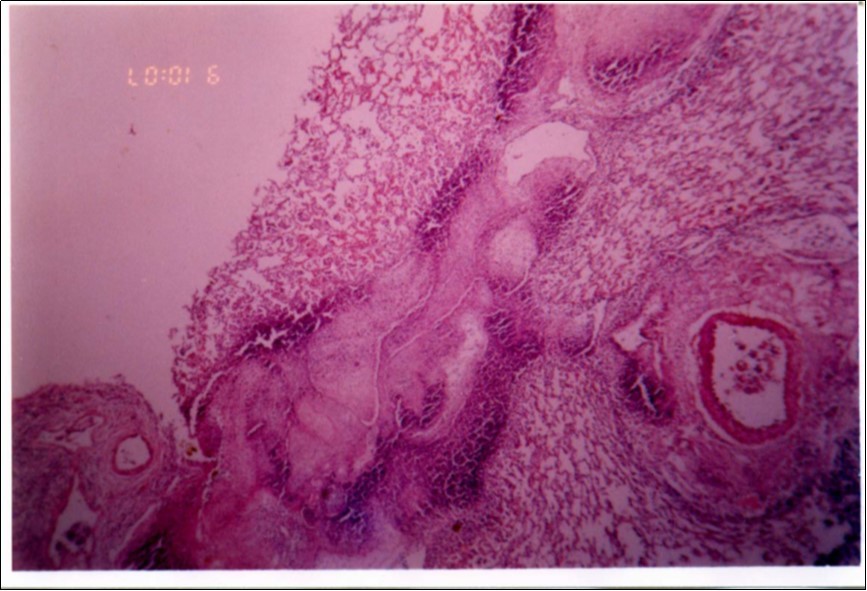 Widened interlobular septa in pneumonic lung tissue (H&E ×200).