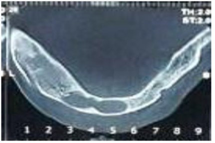 The panoramic radiograph showing multiple cysts in the maxilla and mandible