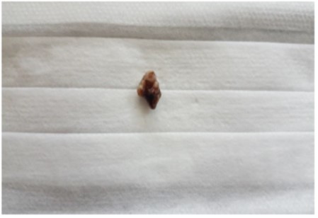 The axial cross-section of the CT scan showing radiolucencies with well-defined borders
