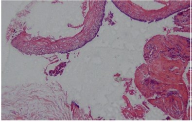 Hematxylin-eosin staining, Para-keratinized stratified squamous epithelium covering the inflammatory odontogenic keratocysts (×10)