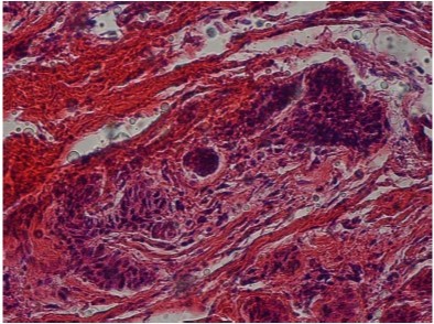 Hematxylin-eosin staining, The odontogenic epithelium in the fibrocollagenous cyst wall