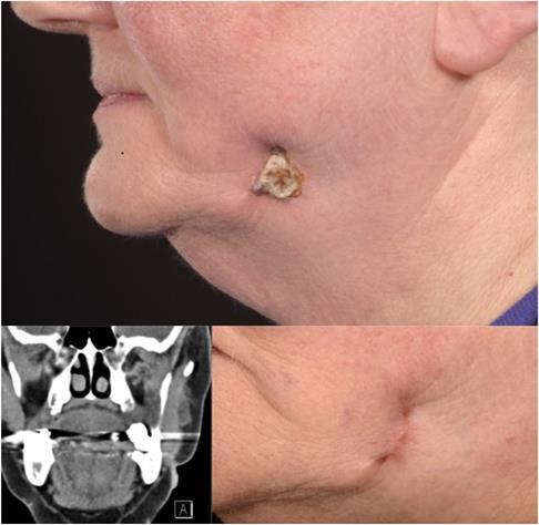 Skin lesion pre-operatively, Computed Tomography scan pre-operatively and scar post-operatively