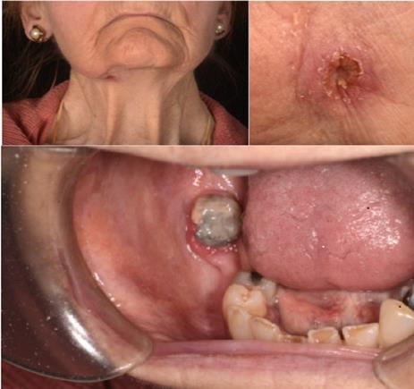 Skin lesion right submental region and intra-oral examination finding
