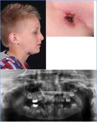 Skin lesion right submental area, OPG mixed dentition with moderately restored LR6 and UR6, a big cavity around the LL6 and periapical radiolucany around LR6